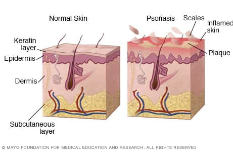 psoriasis e imagen personal