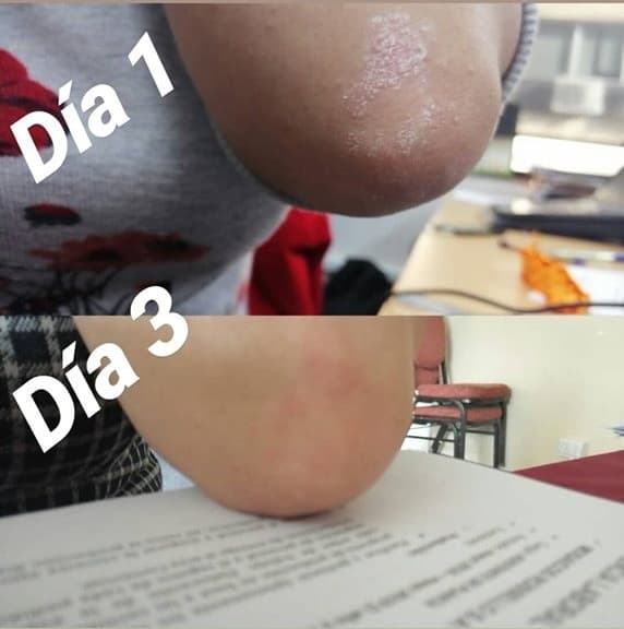 Cremas para la psoriasis