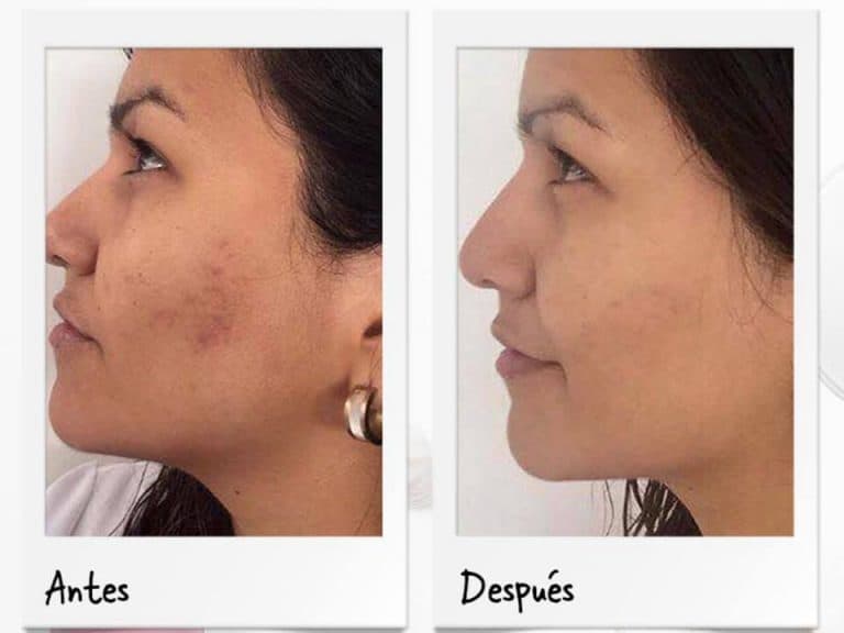 Cremas para rostro - rosacea