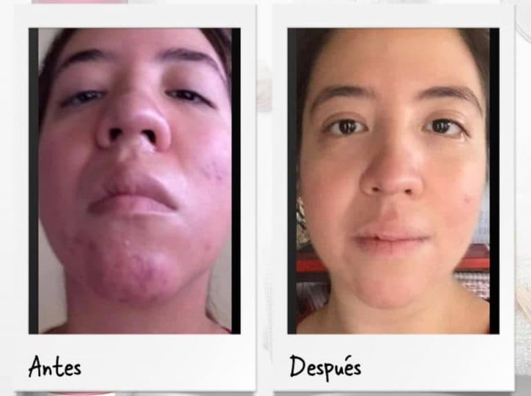 Cremas para rostro acné